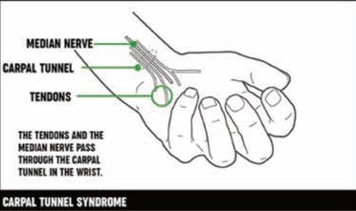 Carpal tunnel syndrome